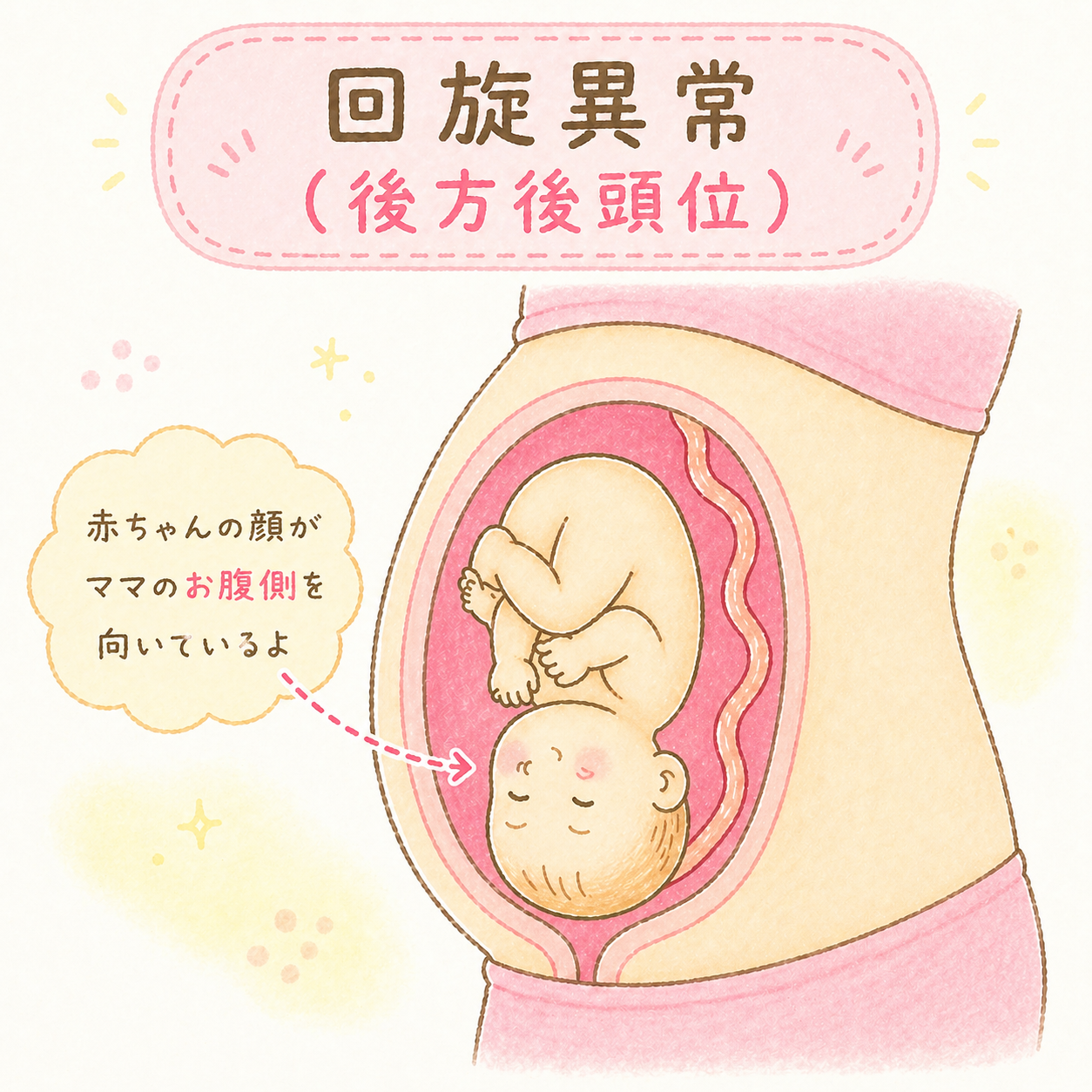 回旋異常（後方後頭位）