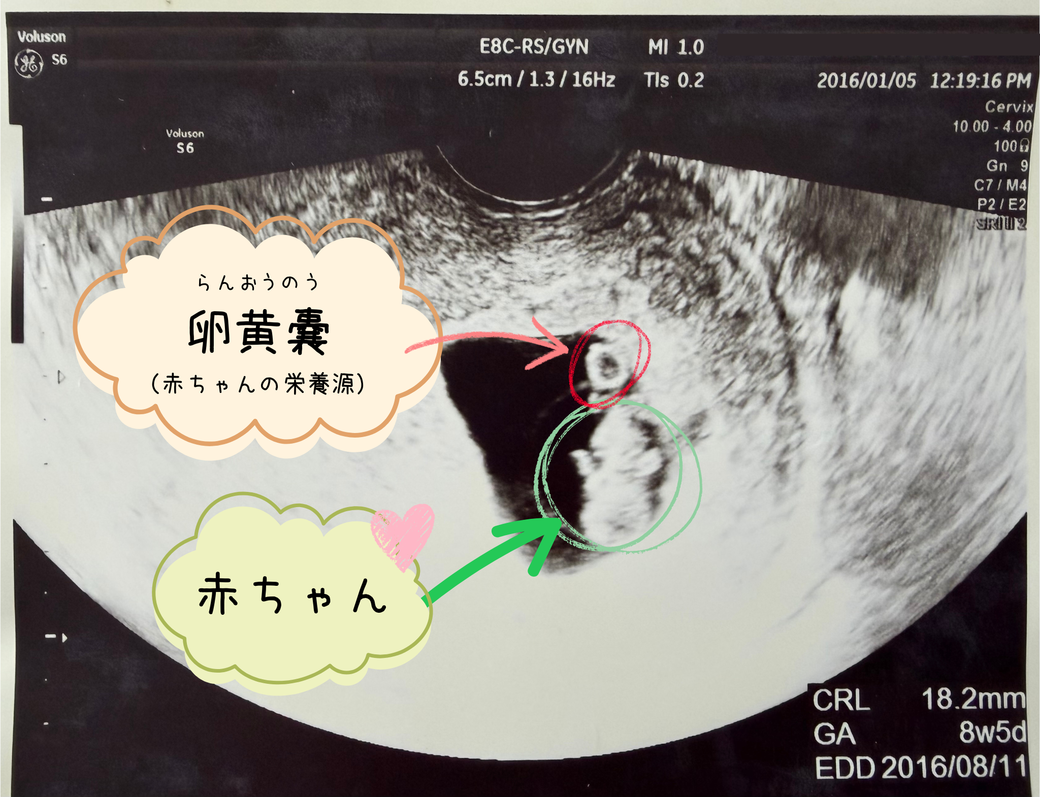 卵黄嚢と赤ちゃんが写ったエコー写真（8週5日）