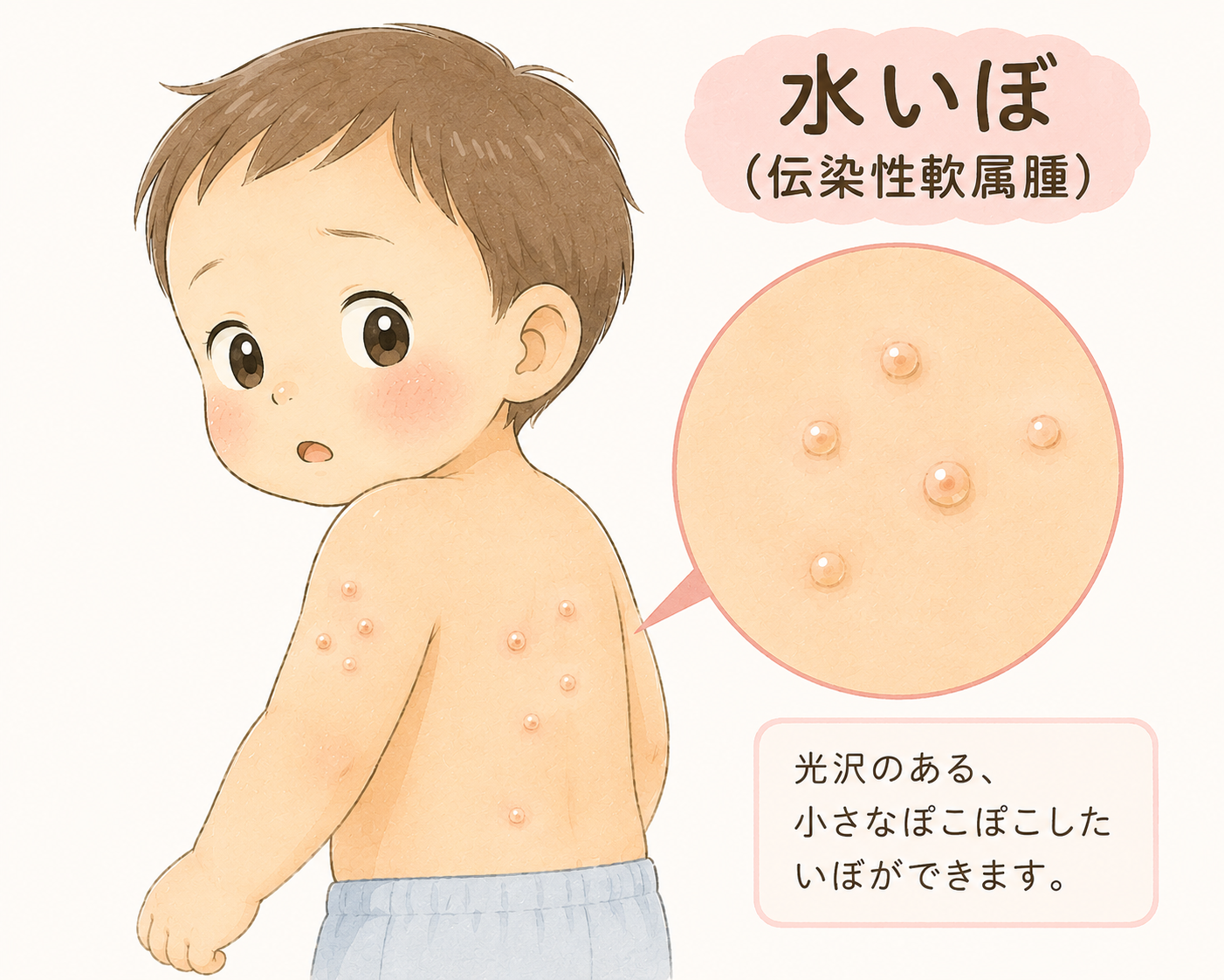 水いぼ(伝染性軟属腫)のイラスト